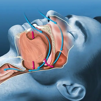 آپنه تنفسی چگونه درمان می شود؟